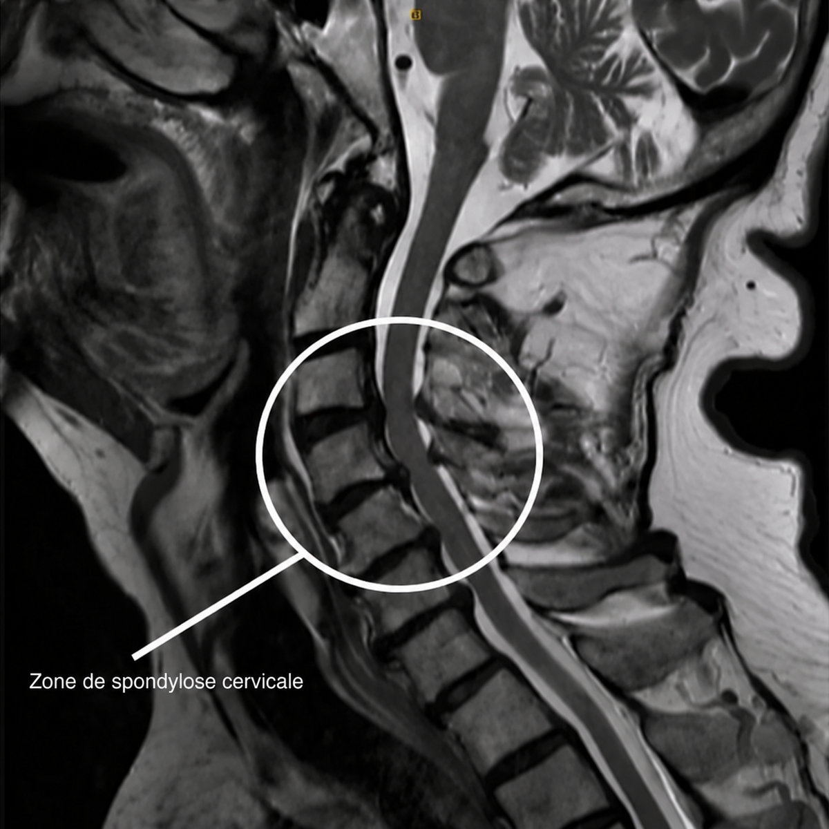 Radiographie de la nuque avec la zone usée en C5 et C6 entourée